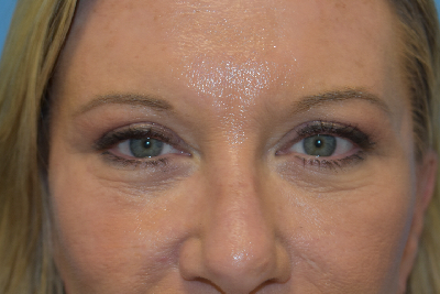 Blepharoplasty (Eyelid Surgery)