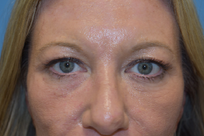 Blepharoplasty (Eyelid Surgery)