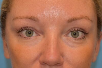 Blepharoplasty (Eyelid Surgery)