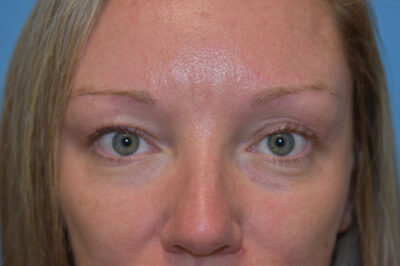 Blepharoplasty (Eyelid Surgery)