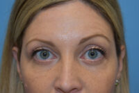 Blepharoplasty (Eyelid Surgery)