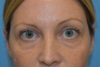 Blepharoplasty (Eyelid Surgery)