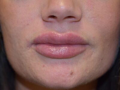 Lip Fillers