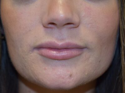 Lip Fillers