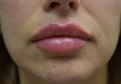 Lip Fillers