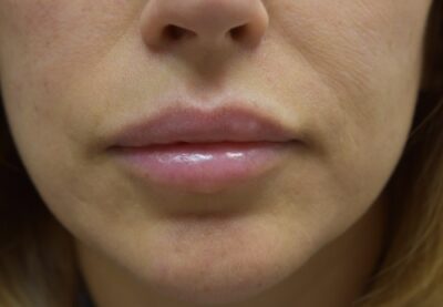 Lip Fillers